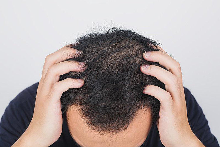 What Are The Causes Of Male Baldness? - youlumistore